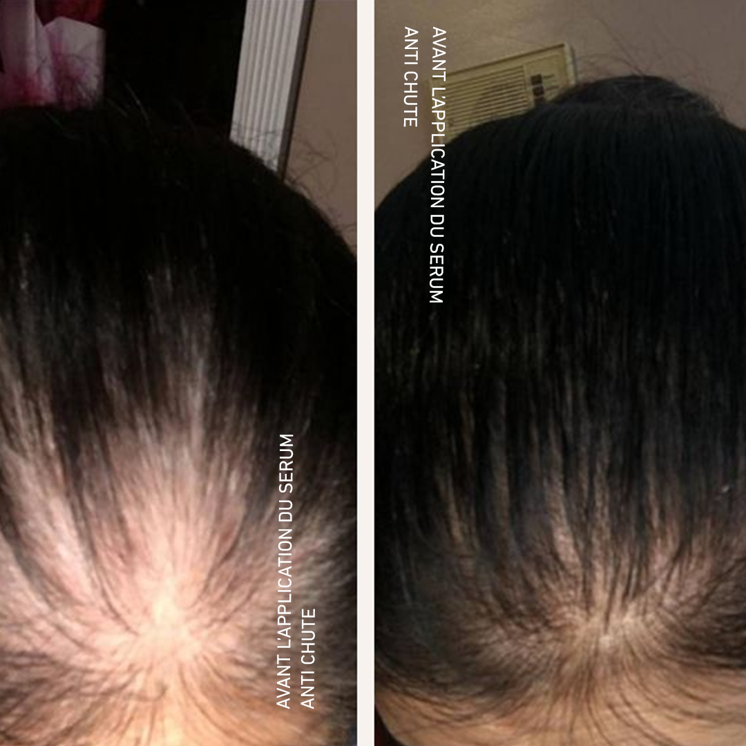 Hair loss control