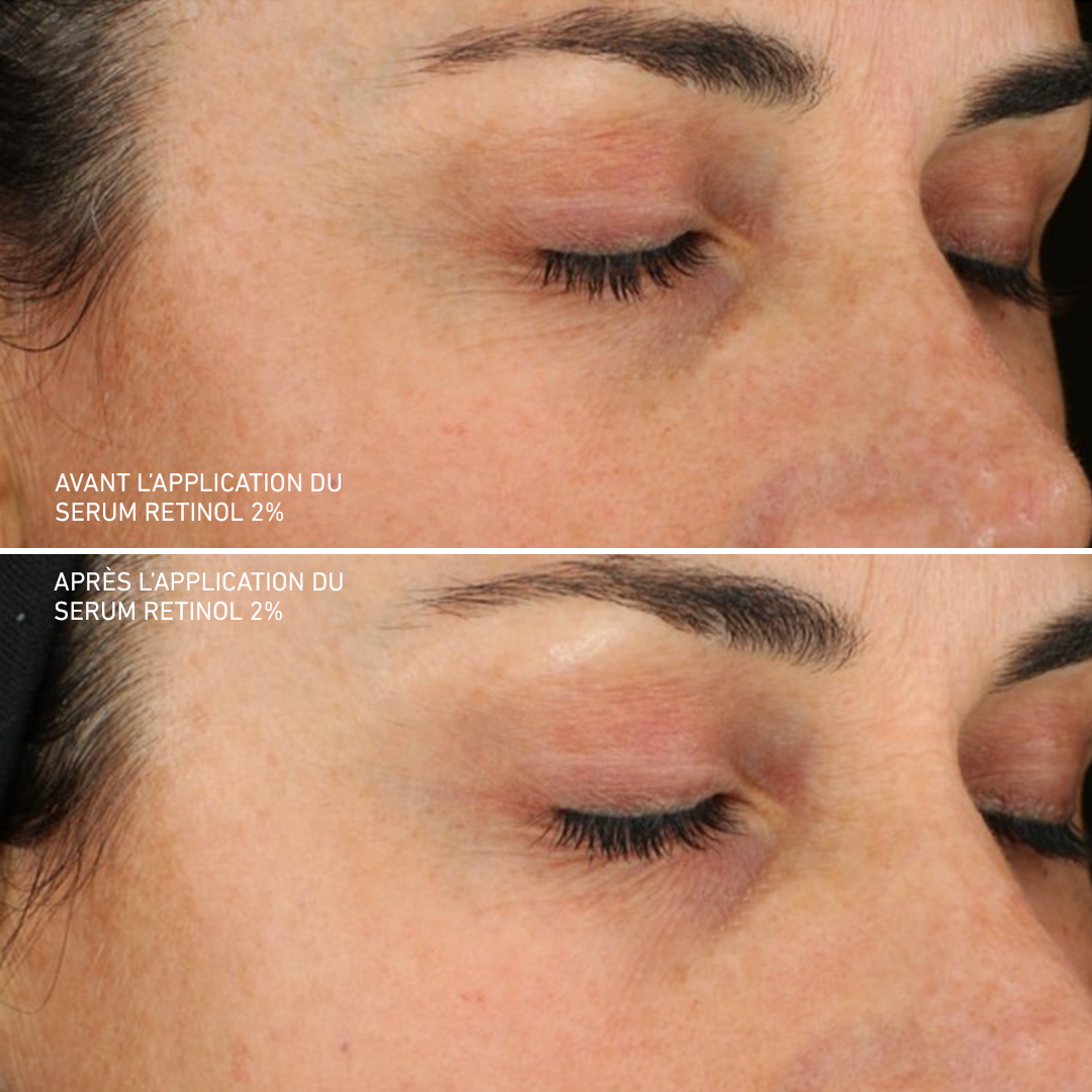 Retinol 2%