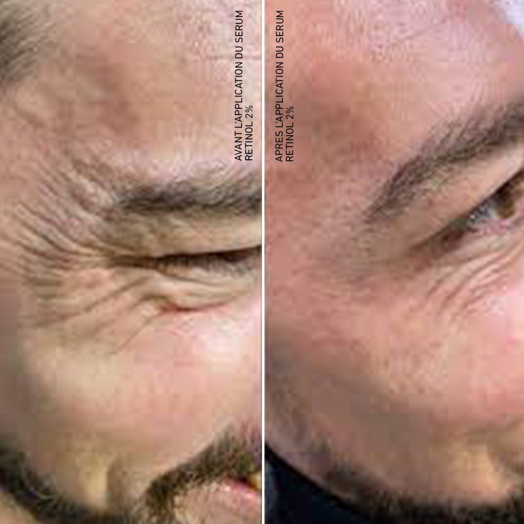 Retinol 2%