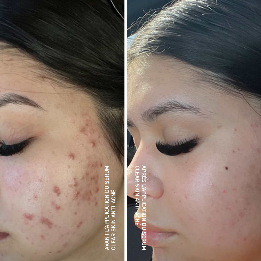 Clear Skin Anti-acné